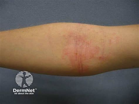 Atopic flexural eczema images