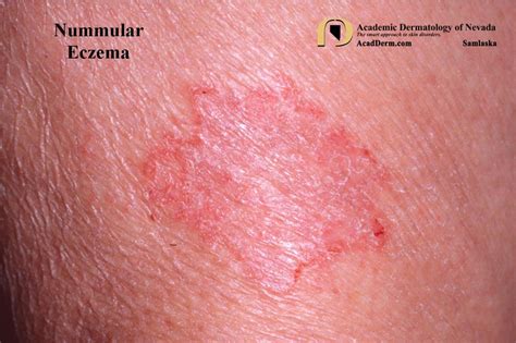 Nummular Eczema: A Comprehensive Guide to Symptoms, Causes, and ...