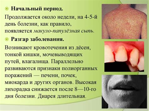Лихорадка Марбург - презентация онлайн