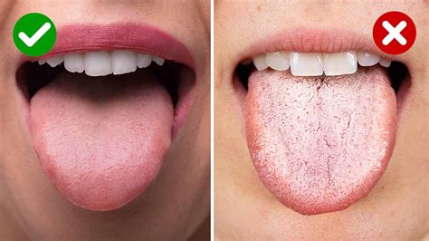 Normal Tongue Coating