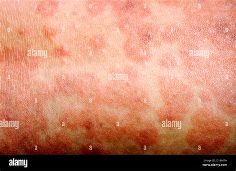 Viral rashes hi-res stock photography and images - Alamy