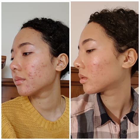 Dairy And Acne Study at Stanley Urbina blog