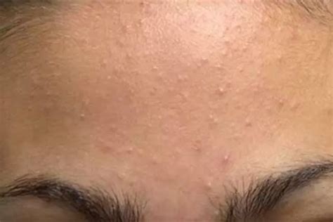 mudah hilangkan tekstur wajah  kulit ayam  ribet