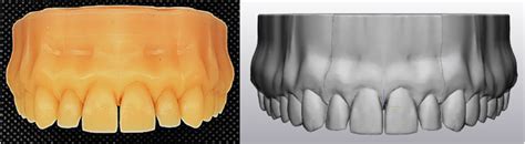 digital model   upper dental arch    um deep space