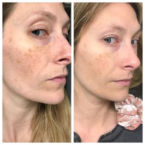 The Ordinary Skincare | Before & After