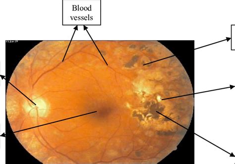 various lesions of retina | Download Scientific Diagram