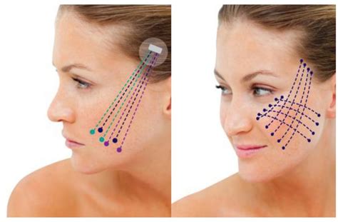 thread facelift  korea  jivaka beauty