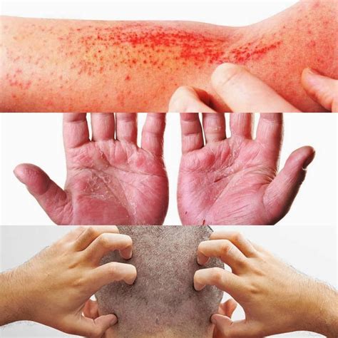 alami masalah kulit berikut  jenis dermatitis   patut