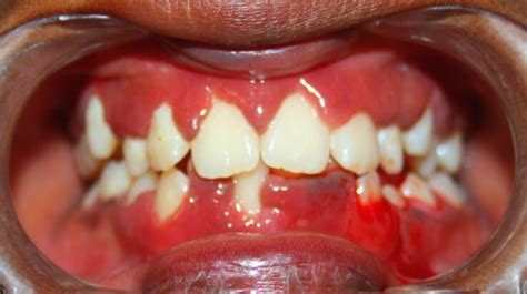journal  clinical pediatric dentistry jocpd