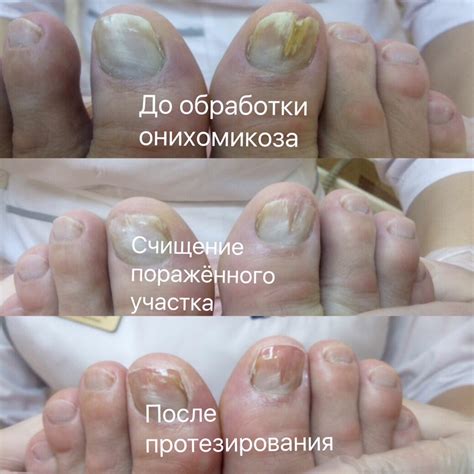Лечебный педикюр в Профи