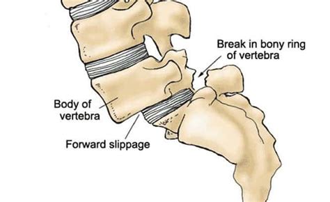 Spondylolisthesis - St. Louis Pain Consultants