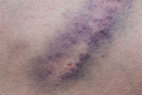 understanding    skin bruising   elderly summerhouse