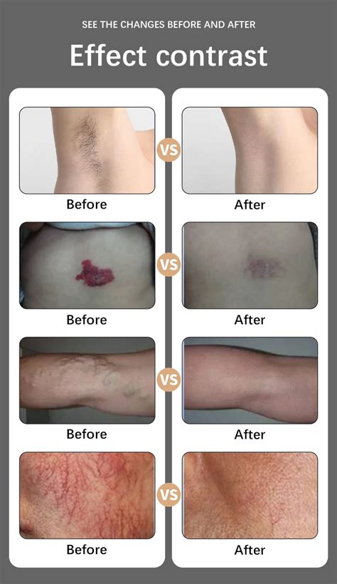 alexandrite laser hair removal machine - vivalaser for you for all for ...