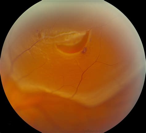 What Is A Retinal Tear In The Eye - Design Talk