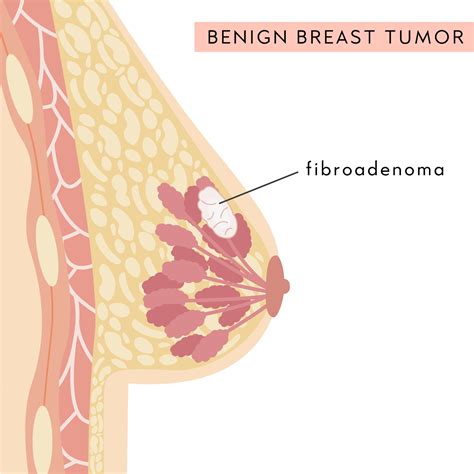 Benign Breast Tumor. Medical Infographic Cross Section of Female Breast