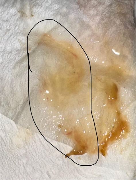 Continuous mucus in stool now with streaks of blood : r/poop