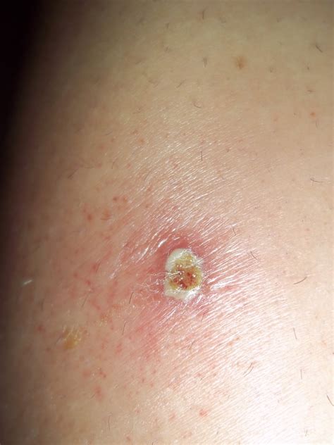 Insect Bites
