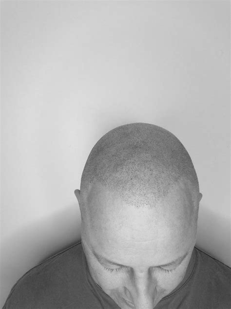 Scalp Micropigmentation - Chrysanthemum Beauty Services