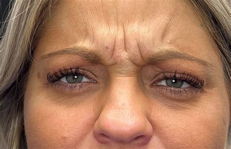 how to fix frown lines