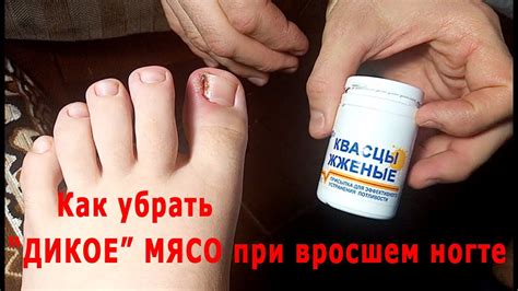Как без хирурга убрать "дикое" мясо при вросшем ногте. Квасцы жженые ...