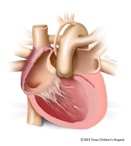 Hypoplastic Left Heart Syndrome (HLHS) | Texas Children's