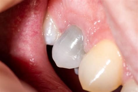 teeth whitening options  gray teeth