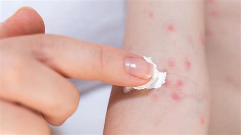 itchy skin rash pictures  symptoms treatment differential