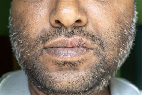 White Spots On Inside Lips Pictures Reddit - Infoupdate.org
