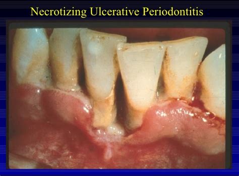 Periodontite Ulcerativa Necrosante Aguda