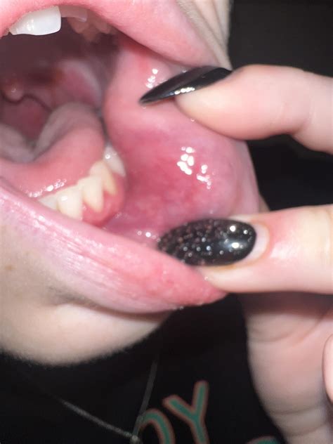 21F, tissue lump with canker sore, scared the outside of my cheek is