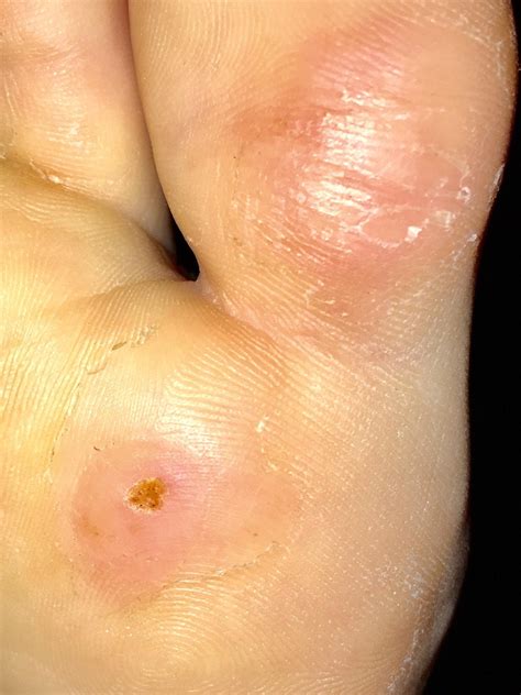 This one on the ball of my right foot is gaining momentum. : u/belbel1234