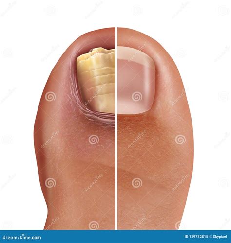 fungal toe home remedy