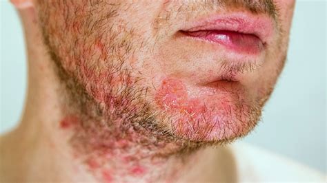 facial eczema images   treatments goodrx