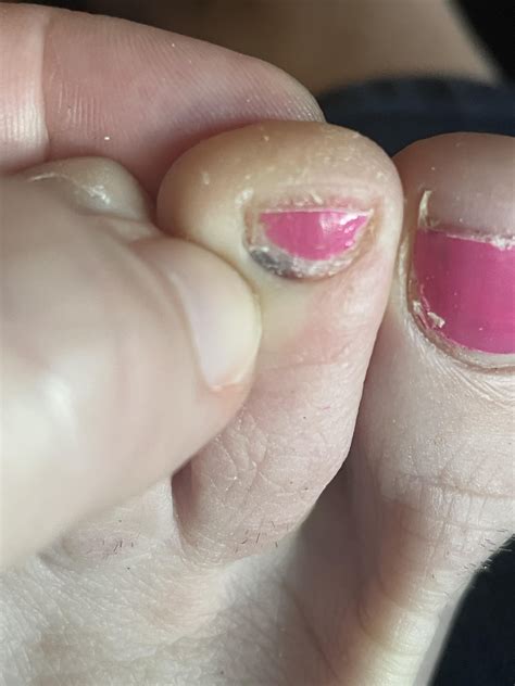Black spot on toe cuticle : r/DermatologyQuestions