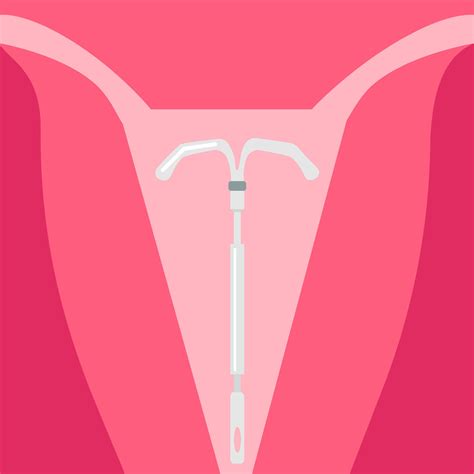 method  contraception   intrauterine spiral illustration