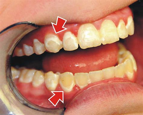 cavity  braces snewqs