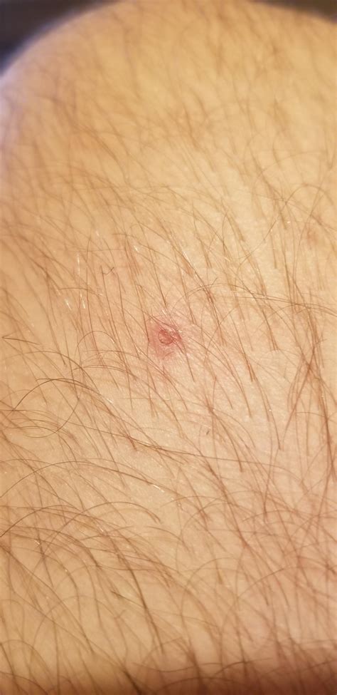 is this a wart? its in my leg. if so, do you treat these the same as