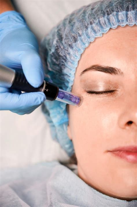 Dermapen – MargoMED Klinika Urody