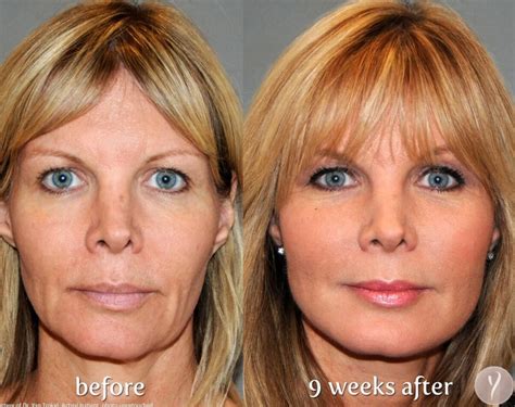 Mini Face Lift Michigan | All About the Mini Face Lift | Skin and Vein