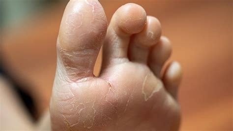 Tips for Managing Foot Psoriasis | Psoriasis feet, Psoriasis, Psoriasis ...