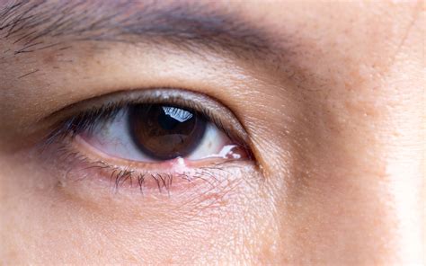 Stye Treatment Adults at Olivia German blog
