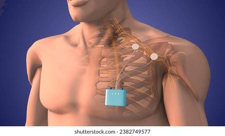 16 Trans Cranial Stimulation Image Images, Stock Photos, 3D objects ...