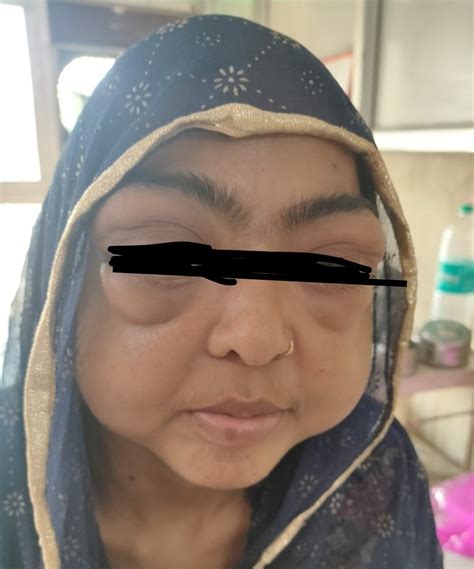 A RARE CONNECTIVE TISSUE DISORDER