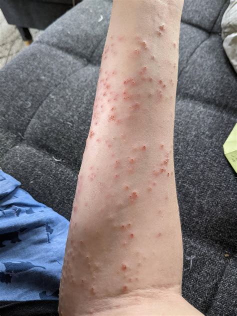Dermatitis Herpetiformis? : r/Celiac