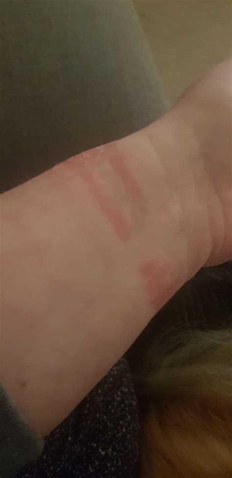 allergic reaction   samsung community