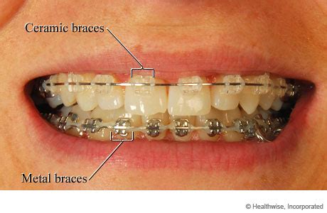 braces video image