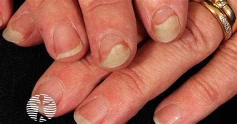 Psoriatic nail dystrophy image