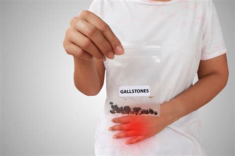 gallstones in toilet bowl 3