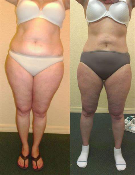UltraSlim® Before and After Photos | Verona Spine & Wellness