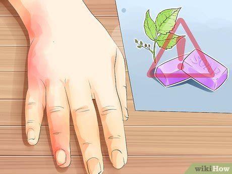 how to treat dermatitis at home